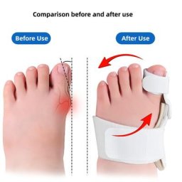 Hallux Valgus Ration tor Big Parker Lisseur pour Enfants Oignon Attelle Pied Orth4WD Instituts