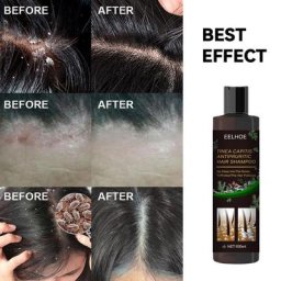 Shampooing thérapeutique antipelliculaire 100ml traitement des démangeaisons du cuir chevelu du